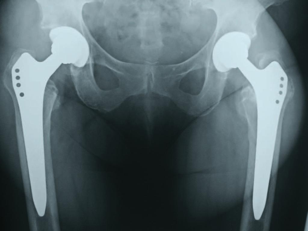 revision surgery, the Allofit-S cup with screw holes offers additional