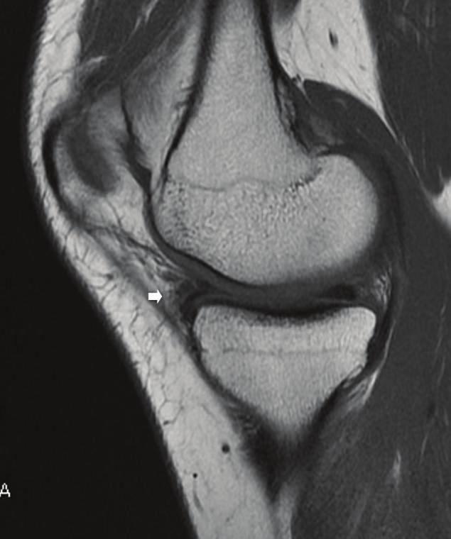 2 Case Reports in Orthopedics Figure 1: Preoperative magnetic