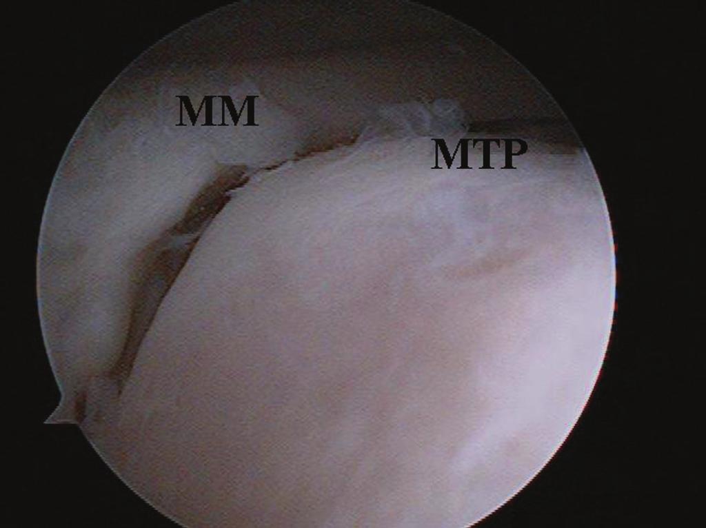 The anterior horn of the medial meniscus was detached and the