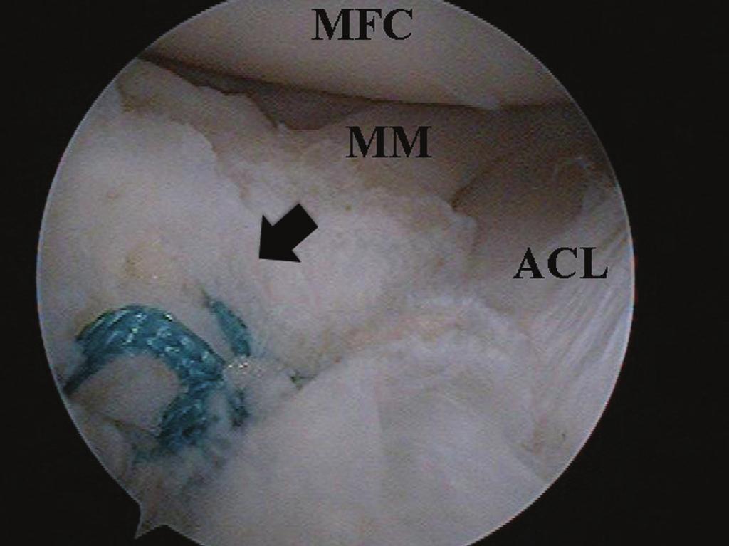 The anterior portion of the medial meniscus was subluxated with the