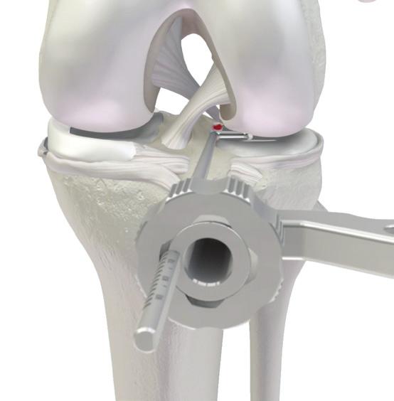 Once the posterior aspect of the tibia is reached, return the Guide to the vertical position and secure the Guide s hook onto the