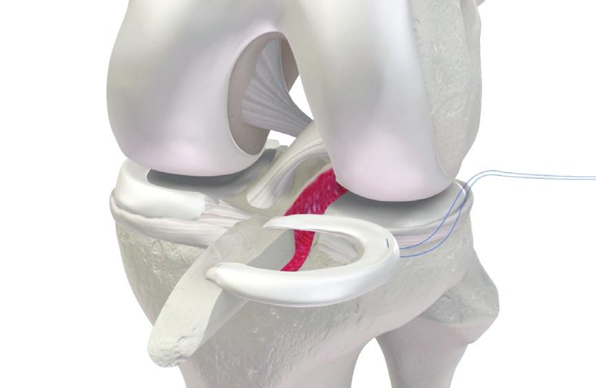 retrieval for the inside-out meniscus repair approach while