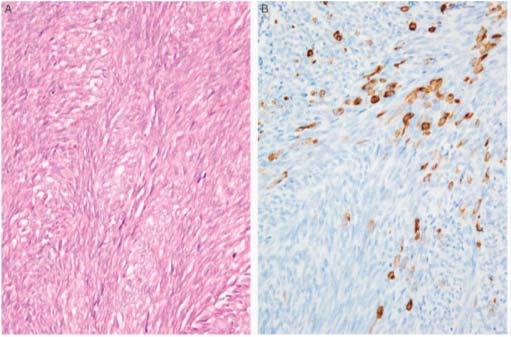 Monophasic synovial sarcoma and MUC4 Sclerosing epithelioid sarcoma, MUC4 and carcinoma Importantly, regarding SEF, in which a poorly differentiated carcinoma may fall into the differential diagnosis