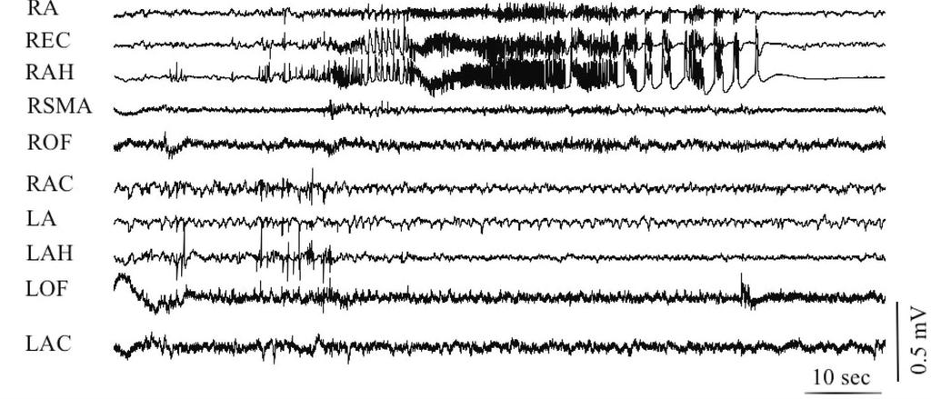 Depth electrode-recorded seizure