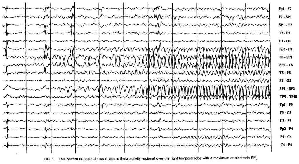 EEG of epileptic
