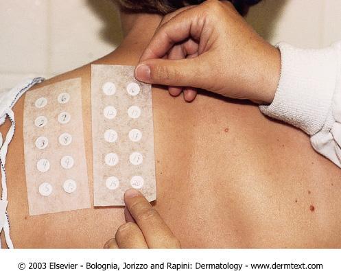 Patch Testing Most common site is the upper back Patients should not have a sunburn in test area, and should not apply topical corticosteroids to the patch test sites for 7 days prior to test