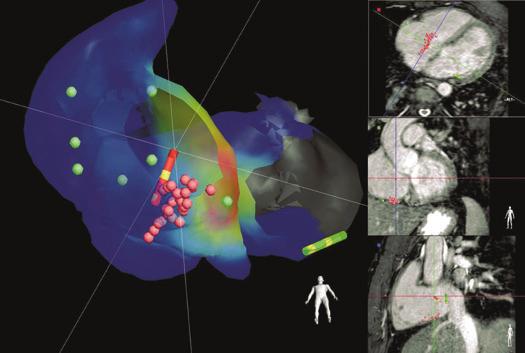 576 S. Hilbert et al. A B C Figure 4 Activation map of the right atrium in LAO from inferior.