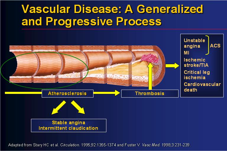 Vascular Disease: A Generalized and Progressive Process Atherosclerosis Thrombosis