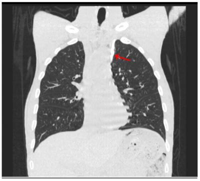 Figure 1 CT Chest showing left sided superior vena cava (Red Arrow)