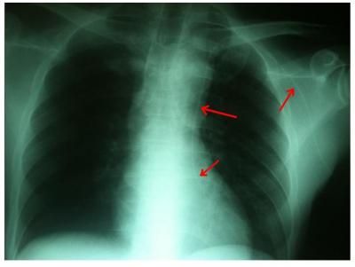 Figure 2 CT Chest showing left sided superior vena cava (Red Arrow)