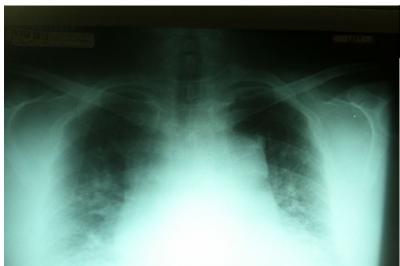 presented to the emergency department because of cough and yellowish sputum of 3 days duration. The patient was evaluated for community-acquired pneumonia.