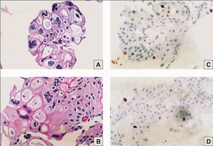 CASE PRESENTATION A 54-year-old man was admitted to Urology Clinic with irritative urinary symptoms (dysuria and frequency) and medical history of nephrolithiasis.