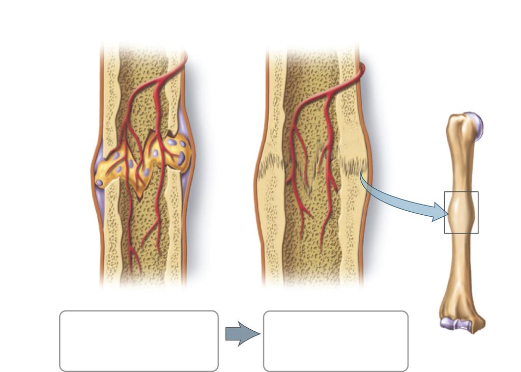When a break occurs, there is bleeding followed by a clot. Fibroblasts secrete collagen fibers that form a callus linking the two parts of the bone. This is later replaced by bone.