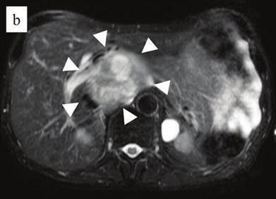 Enhnced computed tomogrphy of the domen reveled slightly enhnced heterogeneous tumor, 18 mm in dimeter, etween the Spiegel loe of the liver nd the IVC in erly-phse imges (Figure 1), with no