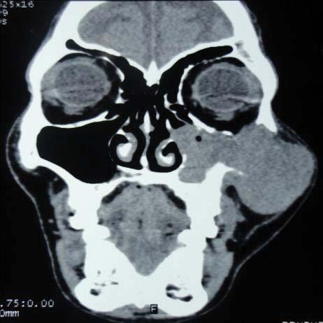 Figure 3: CT-Scan of the paranasal sinuses (coronal & axial) showing the left maxillary