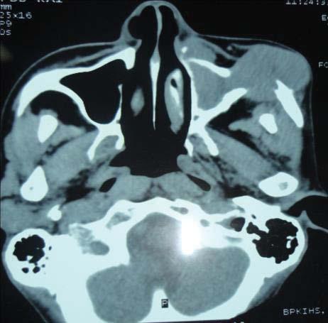 Figure 4: CT-Scan of the paranasal sinuses (coronal & axial) showing the left maxillary 