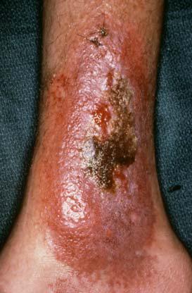 Figure 1. Ulcerated Lower Extremity Lesion Classic appearance of advanced stasis dermatitis secondary to CVI, leading to central ulceration and necrosis.