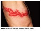 573-74) Chicken pox is caused by Herpesvirus varicellazoster (HHV-3): due to symptoms of initial infection respiratory portal of entry skin cells