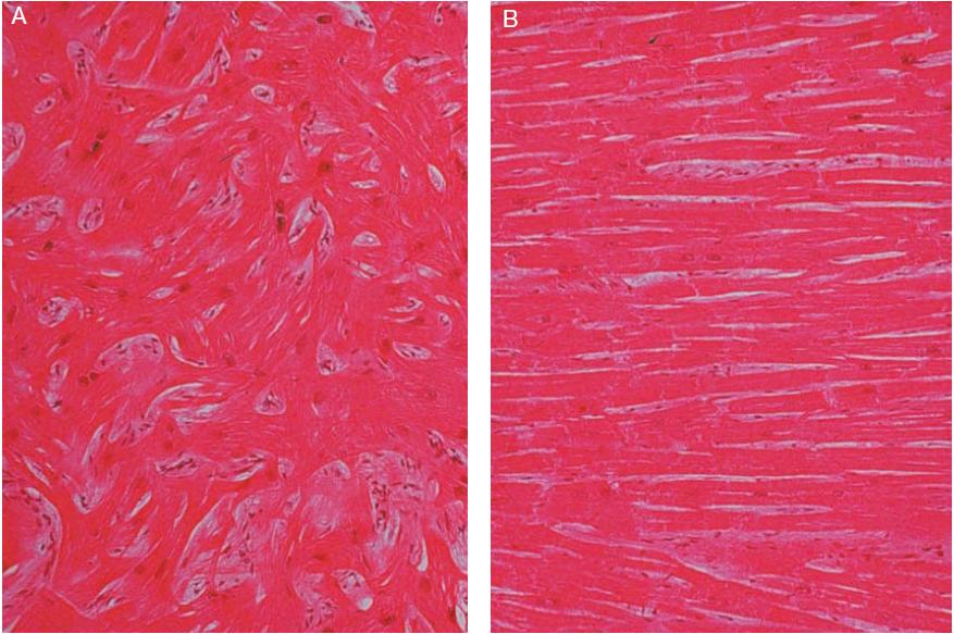 Pathological Hallmark Cardiac myocyte disarray Haphazard alignment of adjacent myocyte