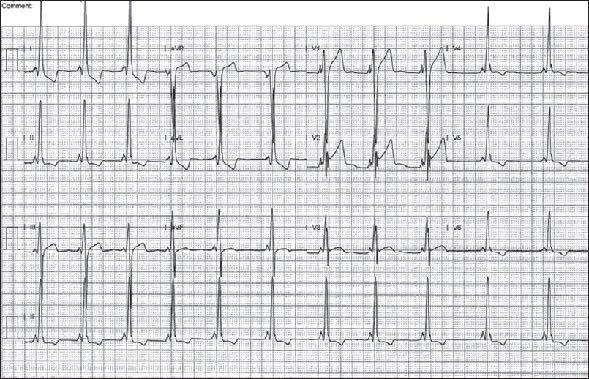 PRKAG2 Syndrome LVH with ventricular