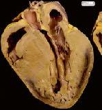 cardiomyopathy (H)