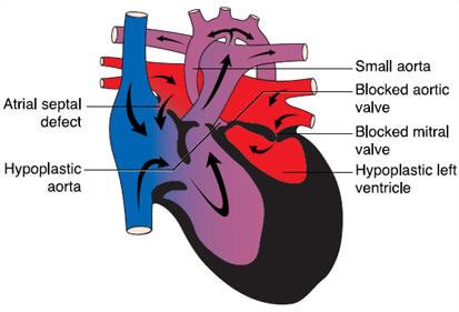 Critical Congenital Heart Defects (CCHD)