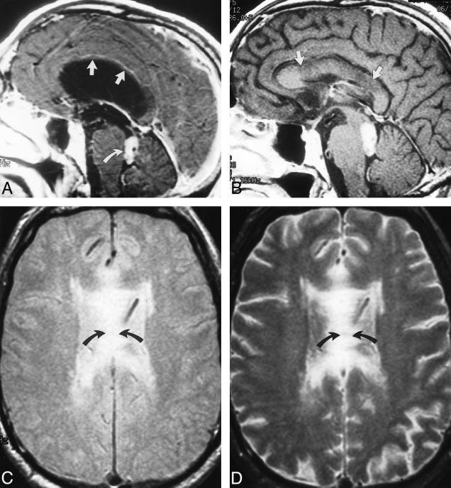 AJNR: 22, January 2001 OBSTRUCTIVE HYDROCEPHALUS 161 FIG 2. Case 7: callosal injury from longstanding obstructive hydrocephalus.
