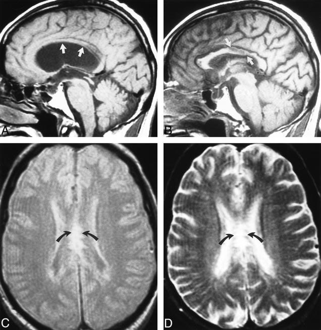 162 LANE AJNR: 22, January 2001 FIG 3. Case 2: callosal injury from longstanding obstructive hydrocephalus in a patient with aqueductal stenosis.