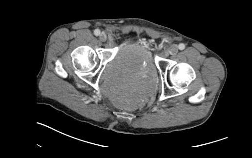 Disseminated disease Bowel obstruction Ureteric