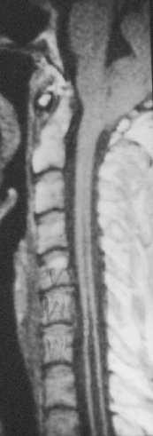 involved) bones meninges spinal cord Chiari