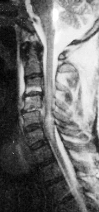 Haemorrhages Spinal cord