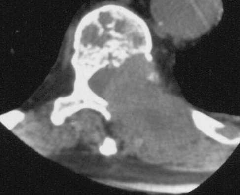Tumours Extradural Bone metastasis