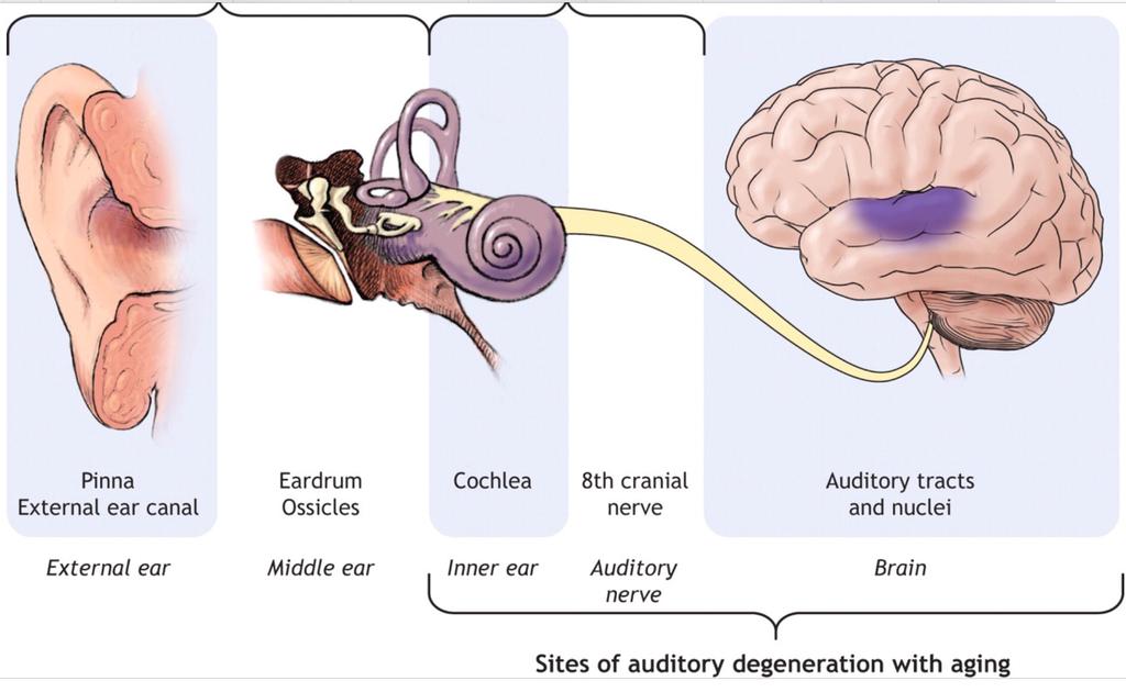 4/24/18 Definition of Central Auditory Processing Disorder (CAPD) A problem not with actually hearing sounds, but with