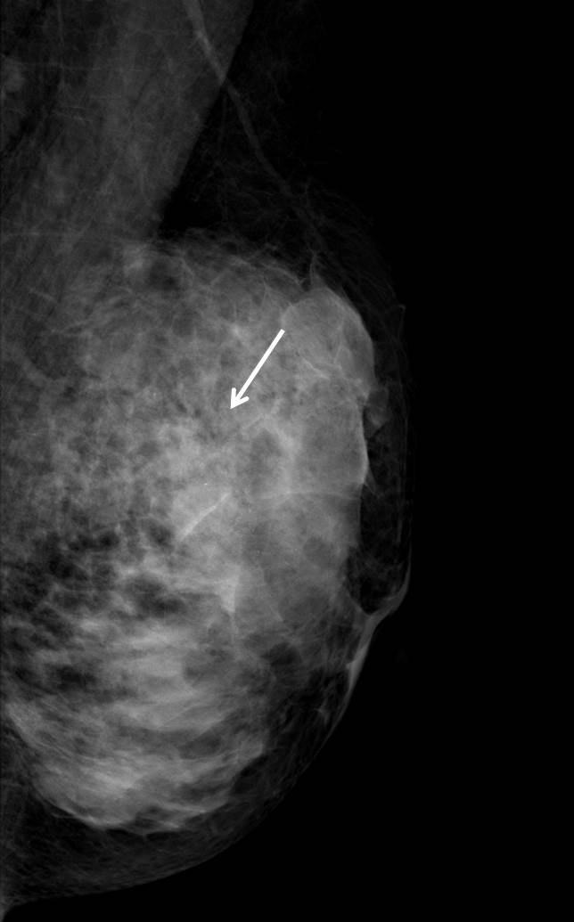 fibroglandular breast tissue. Figure 3.