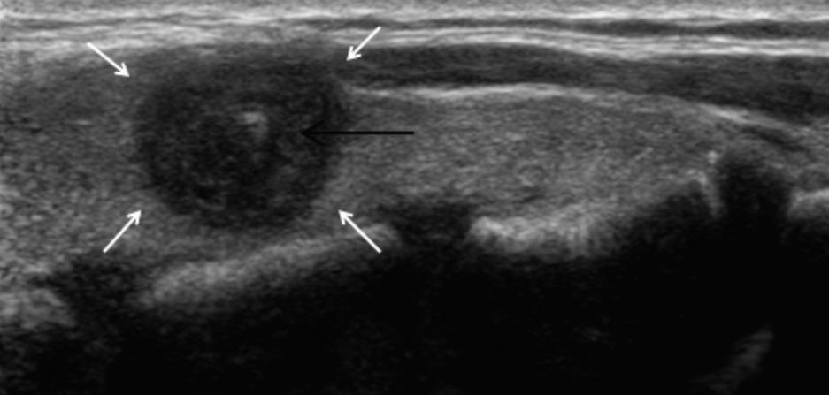 and, Transverse and longitudinal sonograms of the right thyroid gland