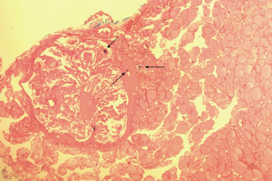 microcalcifications in both lobes of the thyroid gland (white arrows).