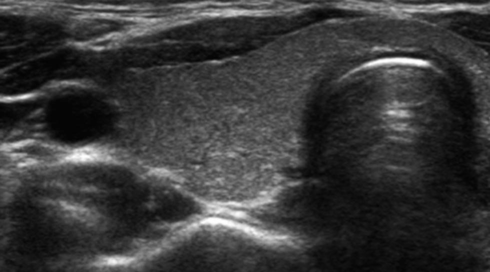 , Transverse sonogram of the left neck at level IV showing a 1-cm lymph