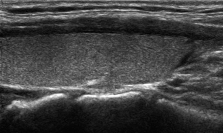 and E, Transverse and longitudinal sonograms of the right thyroid gland