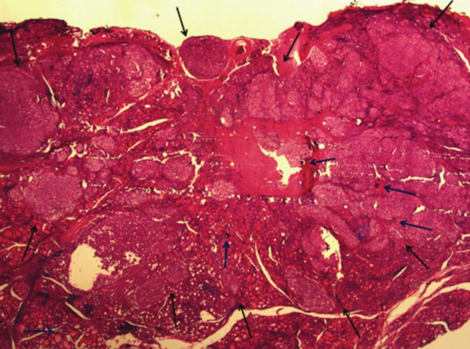 iffuse sclerosing variant of papillary thyroid carcinoma in a 33-year-old woman.