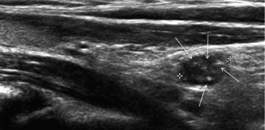 showing a poorly defined hypoechoic mass (black arrows) with internal