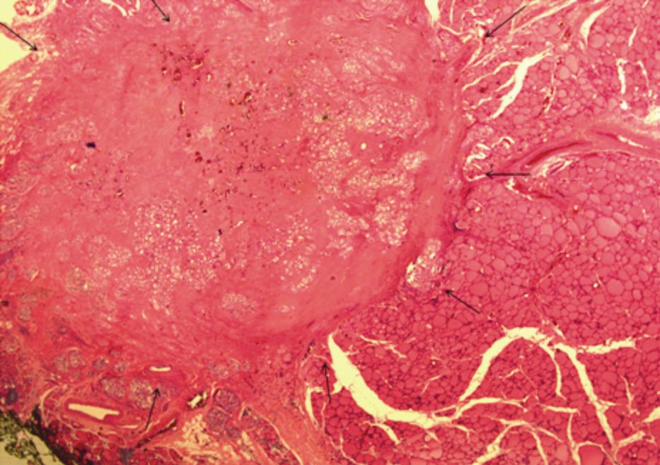 F, Pathologic specimen showing a mass within the thyroid gland (black