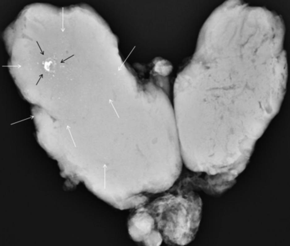 , Specimen radiograph showing dystrophic calcifications (black arrows) and additional areas of scattered microcalcifications (white arrows) consisting of a broader extent of the right thyroid gland