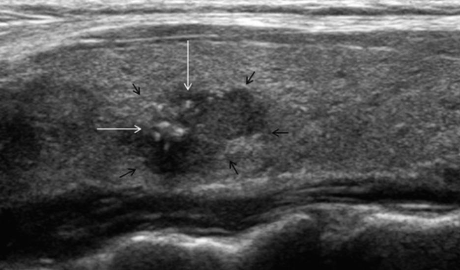 onclusions lthough sonography is an essential modality in the evaluation of thyroid nodules, specimen radiography is more sensitive than sonography for detection of microcalcifications of thyroid
