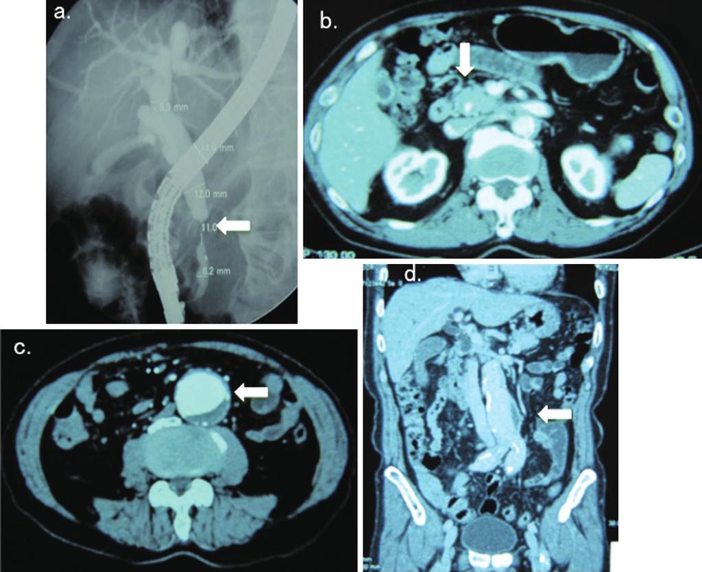 Figure 1. (a) Endoscopic retrograde cholangiopancreatography revealing stenosis in the lower common duct (arrow).