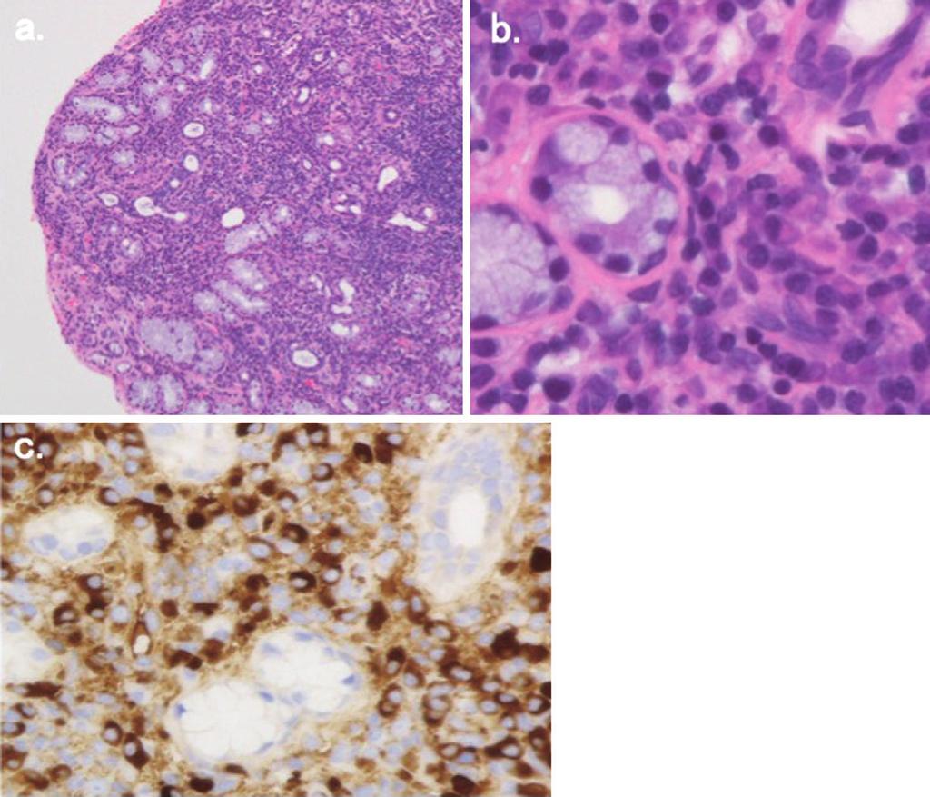 Pathological examination of the salivary glands. Hematoxylin and Eosin staining revealed significant infiltration of plasma cells and fibrotic changes. (a) Low magnification, (b) high magnification.