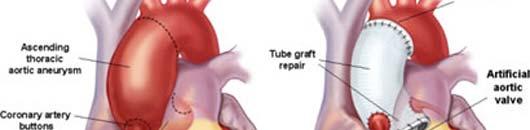 Aortic Root and Arch Surgery