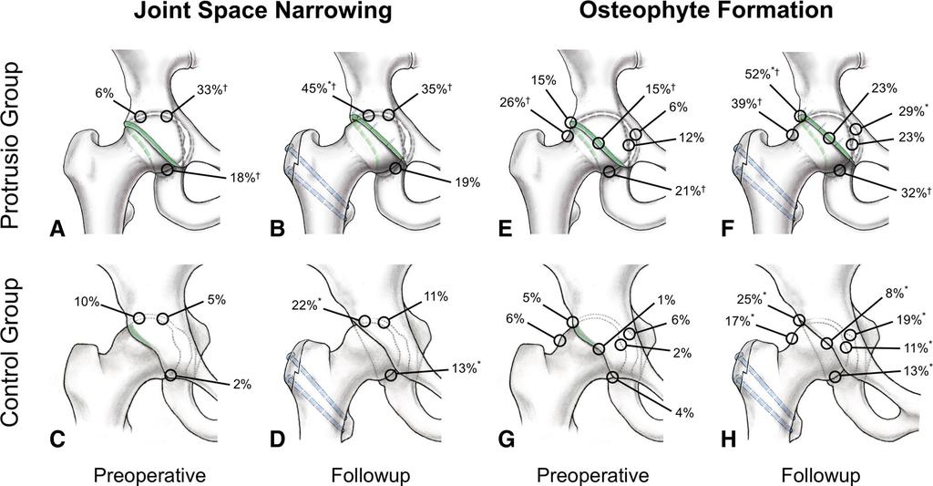 2174 Hanke et al. Clinical Orthopaedics and Related Research 1 a preoperative lateral center-edge angle [52] [ 50 (5.1; 95% CI, 3.5 6.6; p = 0.040), a preoperative Sharp angle [32] \ 34 (4.