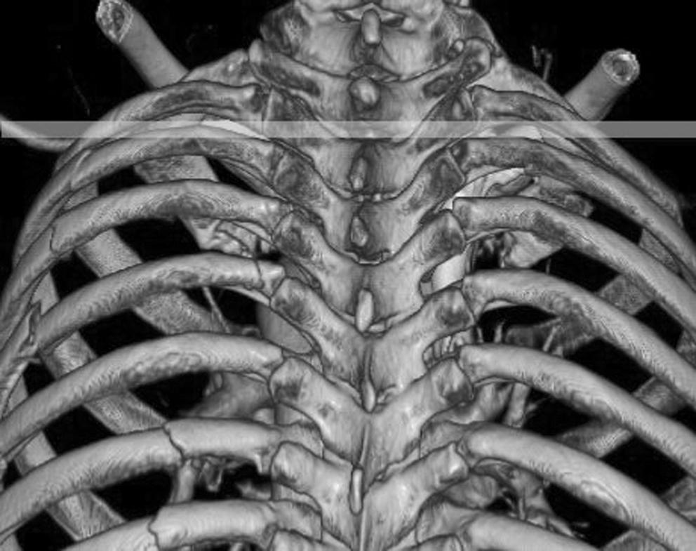 Compared with the three dimensional reconstruction image, the posterior portion of the fifth ribs (large arrow) are upward convex and located higher than the costovertebral joint of the fourth rib