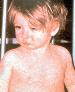 Measles rash covering child's arms and
