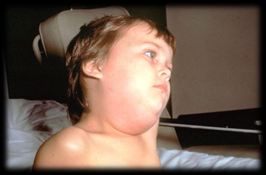 lymphedema of the neck due to a mumps
